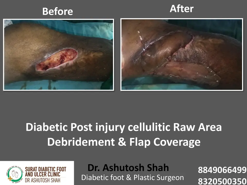 Diabetic Foot  PPT 3 checked by sir.pptx-105.webp